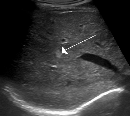 Hämangiom der Leber in der Sonografie (Quelle: Wikipedia)