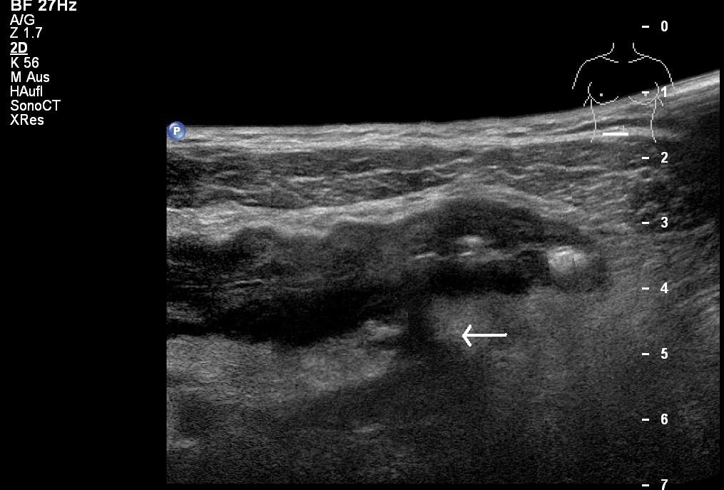 Sonografie: M. Crohn mit Fistel ins parakolische Fettgewebe (mit freundlicher Genehmigung von sonographiebilder.de ©Albertinen-Diakoniewerk e.V., Hamburg).