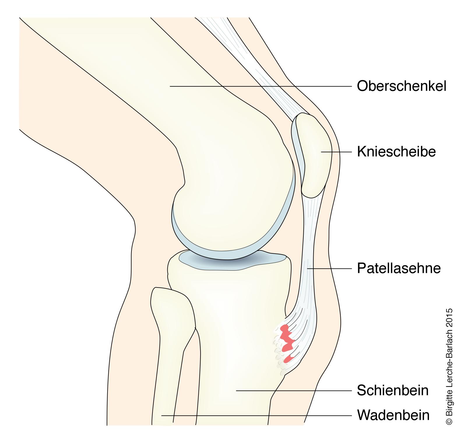 Morbus Osgood-Schlatter.jpg