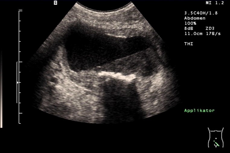 Sonografie: Harnblase mit Sedimentation und Stein (mit freundlicher Genehmigung von sonographiebilder.de ©Albertinen-Diakoniewerk e.V., Hamburg).