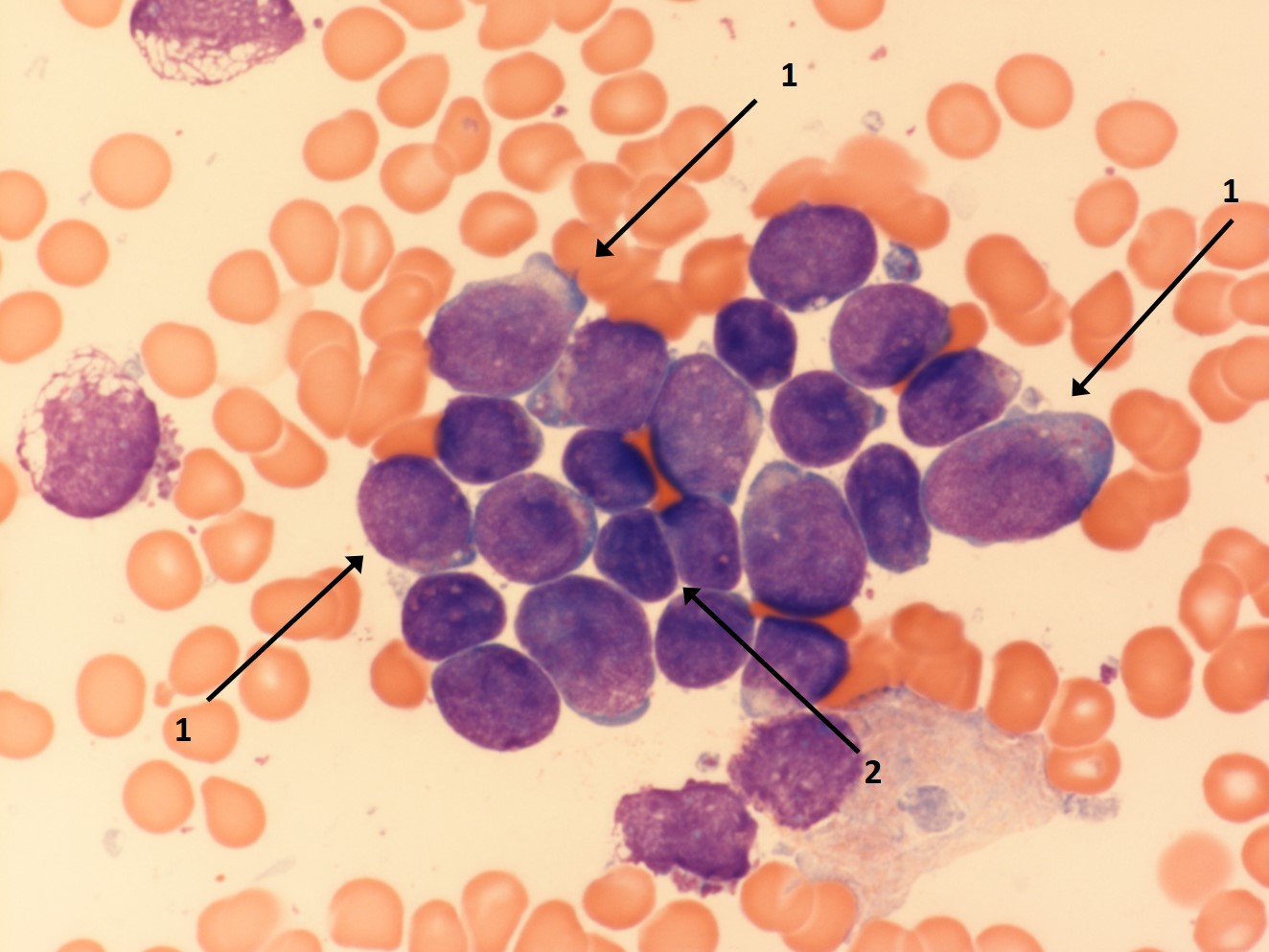 Lymphatische Blasten im Knochenmark (1), dazwischen einige morphologisch unauffällige Lymphozyten (2)