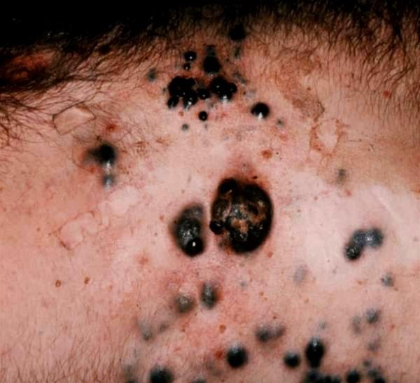 melanotan hudkreft Føflekkreft (malignt melanom) Melanom (føflekkreft) – symptomer og