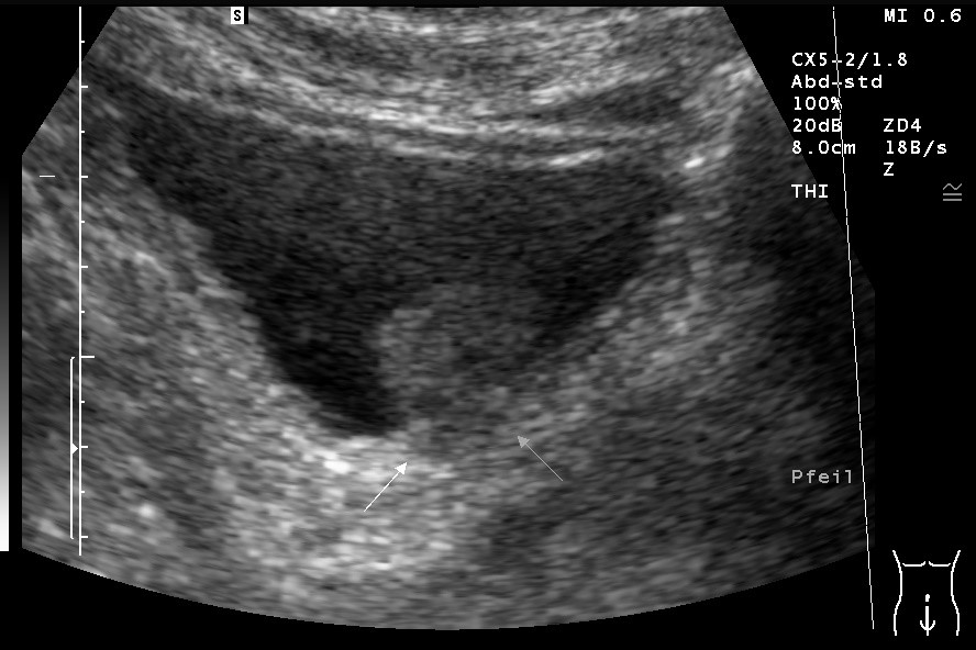 Sonografie: Tumor der Harnblase (mit freundlicher Genehmigung von sonographiebilder.de ©Albertinen-Diakoniewerk e. V., Hamburg)