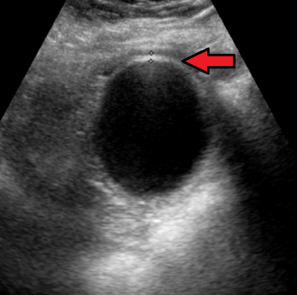 Akute Cholezystitis mit leicht verdickter Gallenblasenwand (3,5 mm, Pfeil) in der Sonografie (Quelle: Wikipedia, CC BY-SA 4.0)