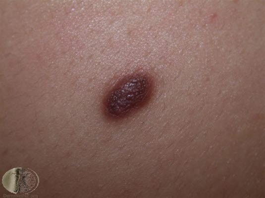 Fotoet viser dermatofibrom, pigmentert