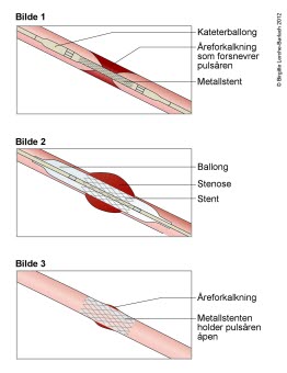 Stentbehandling av innsnevret arterie