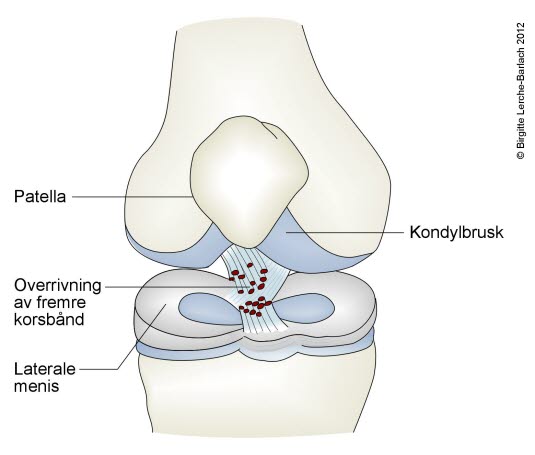 Fremre korsbåndskade