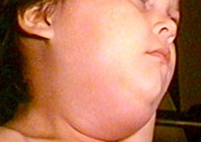 Mumps-1.0.jpg