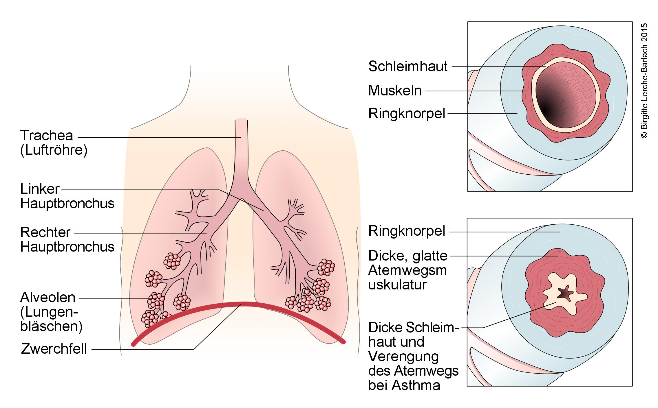 Atemwege und Veränderungen bei Asthma bronchiale