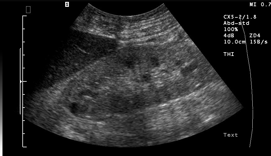 Sonografie: Akute Glomerulonephritis mit etwas echoreicherer, vergrößerter Niere (mit freundlicher Genehmigung von sonographiebilder.de ©Albertinen-Diakoniewerk e. V., Hamburg).