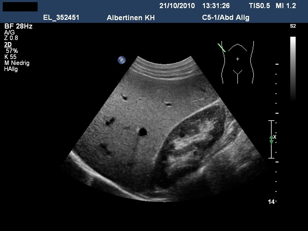 Sonografie: echoreiche Fettleber bei metabolischem Syndrom (Mit freundlicher Genehmigung von sonographiebilder.de ©Albertinen-Diakoniewerk e.V., Hamburg)