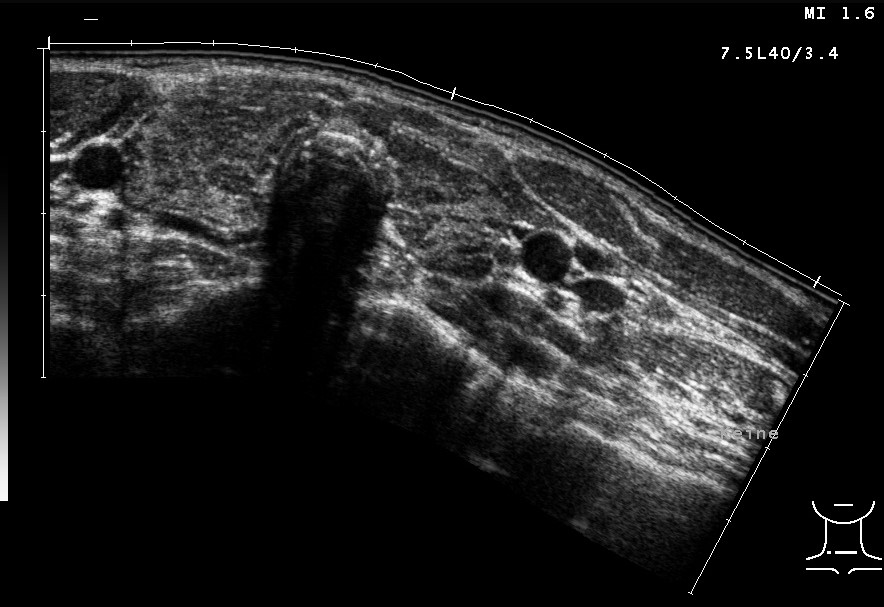 Hashimoto-Thyreoiditis in der Sonographie, kleine inhomogene Schilddrüse 