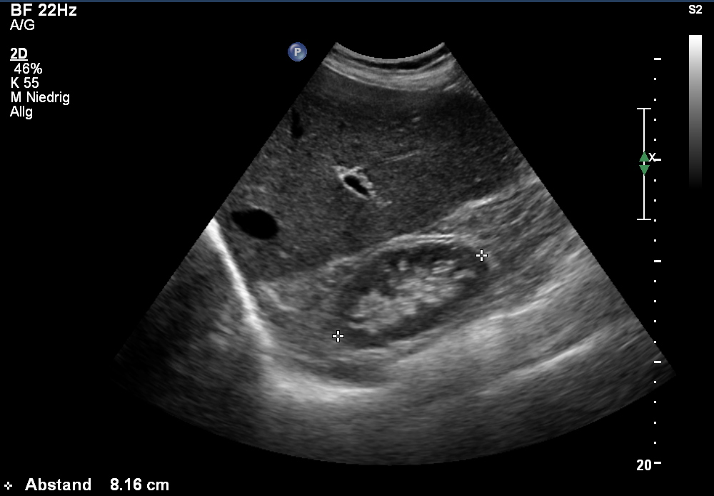 Sonografie: Schrumpfniere (vaskuläre Nephropathie bei Nierenarterienstenose) (mit freundlicher Genehmigung von sonographiebilder.de ©Albertinen-Diakoniewerk e. V., Hamburg)