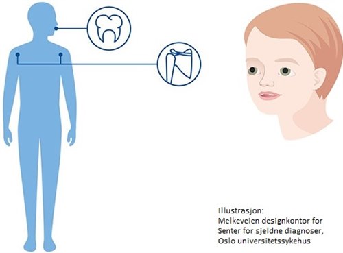 Cleidocranial dysplasi.jpg