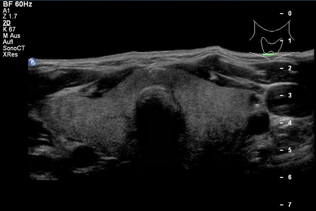 Struma diffusa in der Sonografie (mit freundlicher Genehmigung von sonographiebilder.de ©Albertinen-Diakoniewerk e. V., Hamburg)