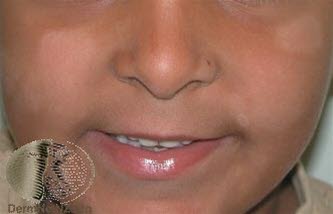 Fotoet viser pityriasis alba