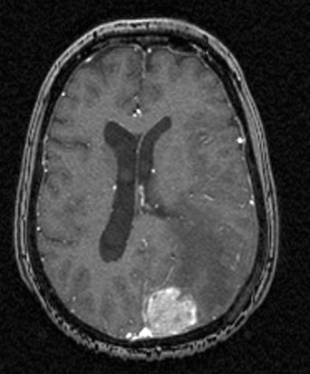 Hirnmetastase bei Brustkrebs, axialer Schnitt