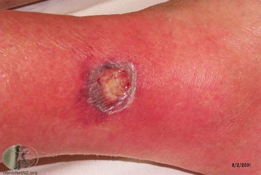 Fotoet viser pyoderma gangrenosum (typisk underminert kant)
