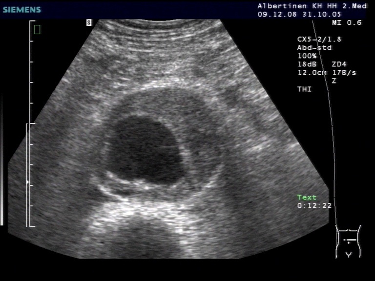 Bauchaortenaneurysma im Querschnitt in der Sonografie. Mit freundlicher Genehmigung von sonographiebilder.de (©Albertinen-Diakoniewerk e.V., Hamburg)