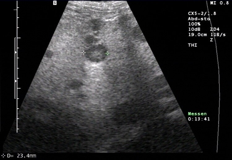 Sonografie: Lebermetastase mit typischem Halo und dorsaler Schallverstärkung