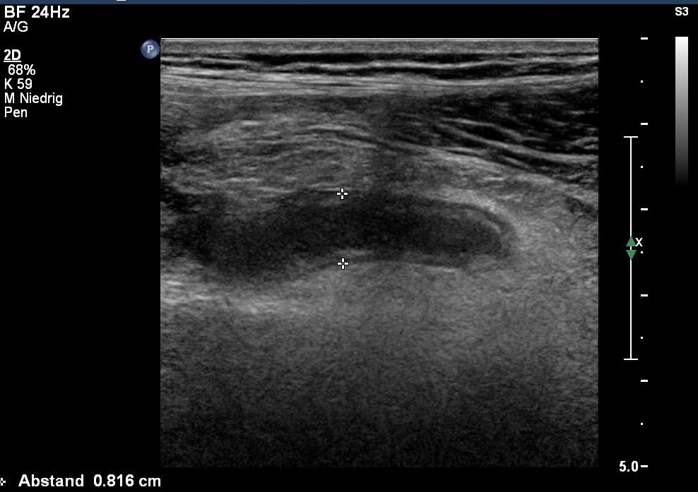 Sonografie: Appendizitis mit entzündlicher Umgebungsreaktion im Längsschnitt (mit freundlicher Genehmigung von sonographiebilder.de ©Albertinen-Diakoniewerk e. V., Hamburg).