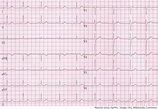 EKG, normalt