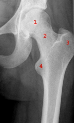 Unauffällige Hüfte, von vorn: 1 = Hüftkopf, 2 = Oberschenkelhals, 3 = Trochanter major, 4 = Trochanter minor.