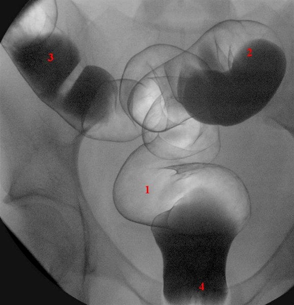 Rektum (1) und Sigmoid (2 und 3) in Frontansicht : Ballonkatheder im Rektum (4) ist teilweise von Barium verdeckt.