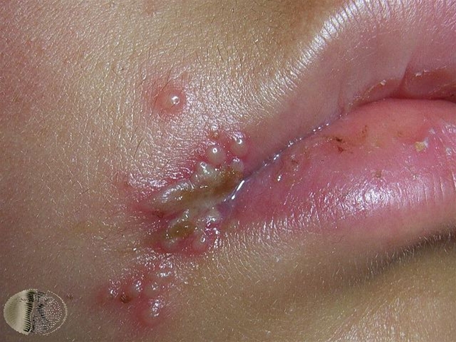 Herpes simplex labialis