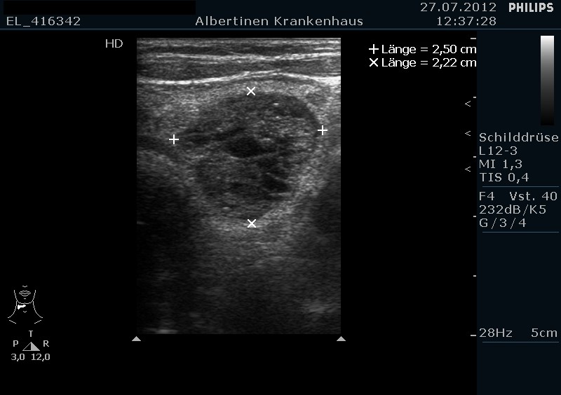 Struma multinodosa in der Sonografie, großer Knoten im linken SD-Lappen (mit freundlicher Genehmigung von sonographiebilder.de ©Albertinen-Diakoniewerk e. V., Hamburg).