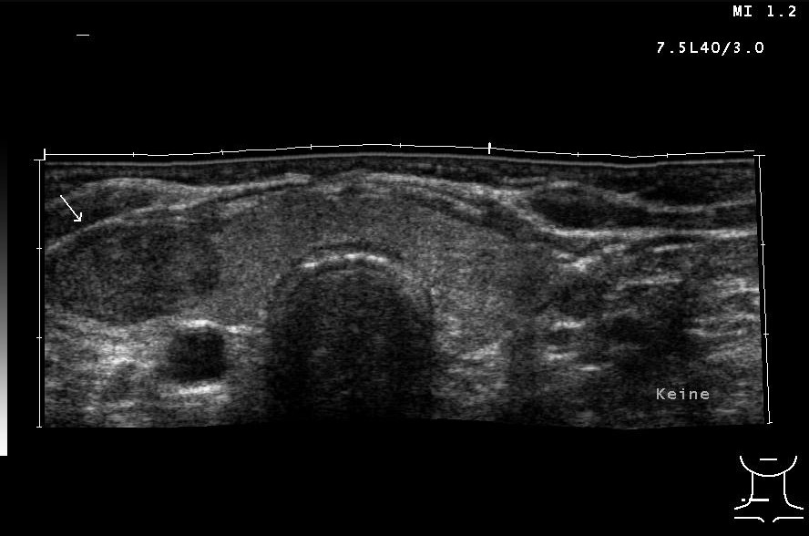 Solider Schilddrüsenknoten rechts in der Sonografie (mit freundlicher Genehmigung von sonographiebilder.de ©Albertinen-Diakoniewerk e. V., Hamburg).