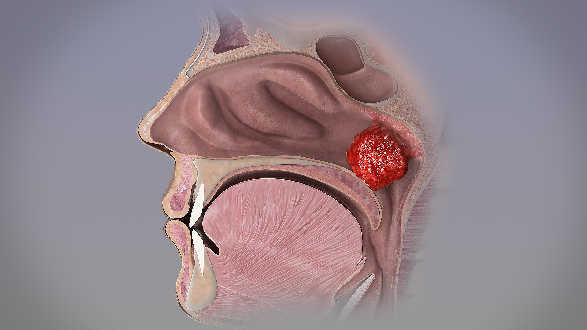 Adenoid_hypertrophy.jpg