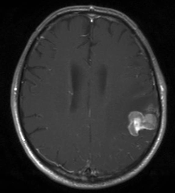 Hirnmetastase bei Nierenzellkarzinom, Transversalebene