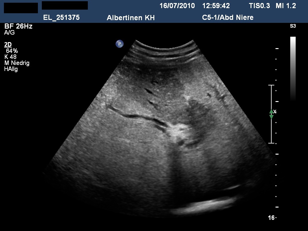 Sonographie: Intrahepatischer Tumor mit biliärer Segmentfibrose (Mit freundlicher Genehmigung von sonographiebilder.de ©Albertinen-Diakoniewerk e.V., Hamburg)