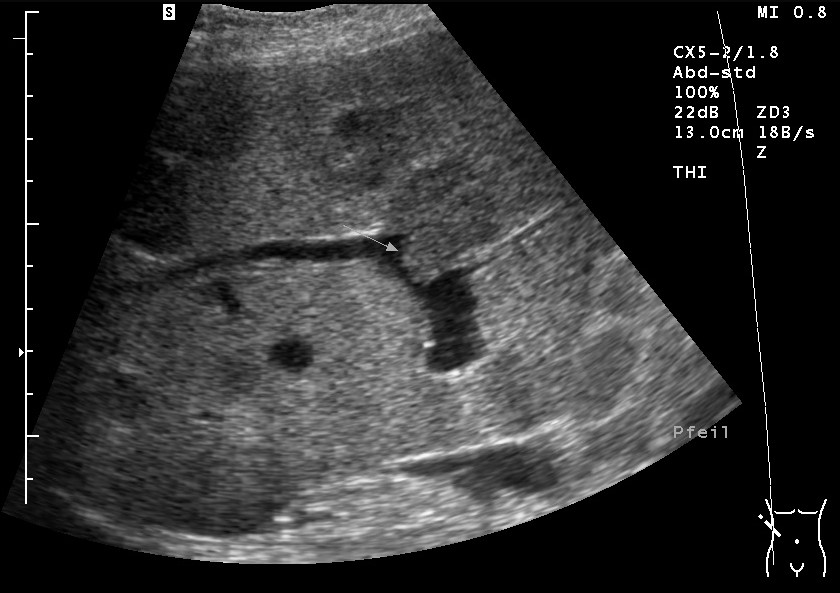 Sonografie: Lebermetastase eines Ovarialkarzinoms mit Gefäßinvasion