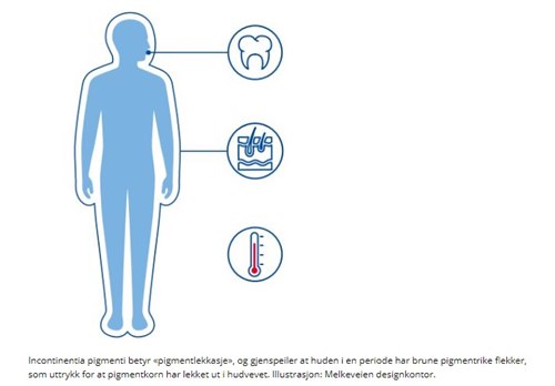 Incontinentia pigmenti (IP).jpg