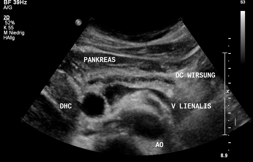 Sonografie: Erweiterter Ductus wirsungianus bei Pankreaskarzinom (mit freundlicher Genehmigung von sonographiebilder.de ©Albertinen-Diakoniewerk e. V., Hamburg)