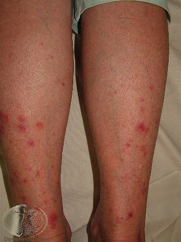 soleksem (polymorf lysdermatose) 1