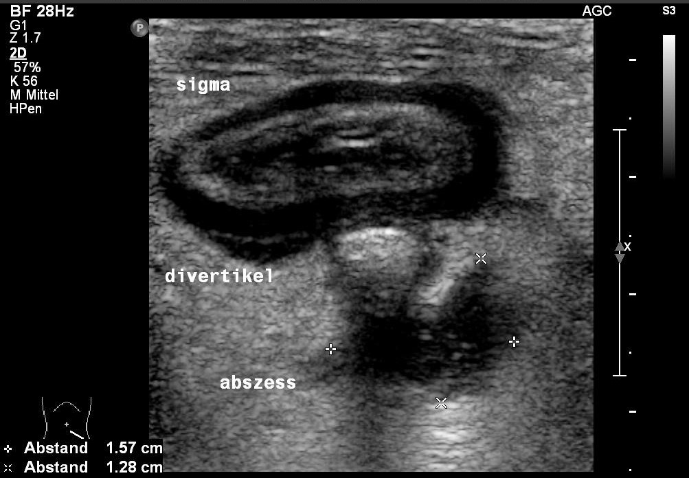 Sonografie: Divertikulitis mit Kotstein im Divertikel sowie Imbibierung des Fettgewebes und Abszess