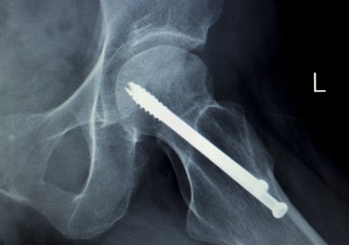 Røntgenbilde av venstre hofte, sett forfra, med skrue som fikserer hode og skaft av femur.