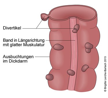 Kolondivertikel.jpg