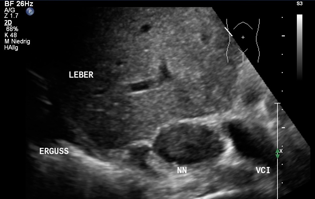 Inzidentalom: Zufallsbefund Nebennierenvergrößerung in der Sonografie (Mit freundlicher Genehmigung von sonographiebilder.de ©Albertinen-Diakoniewerk e.V., Hamburg)