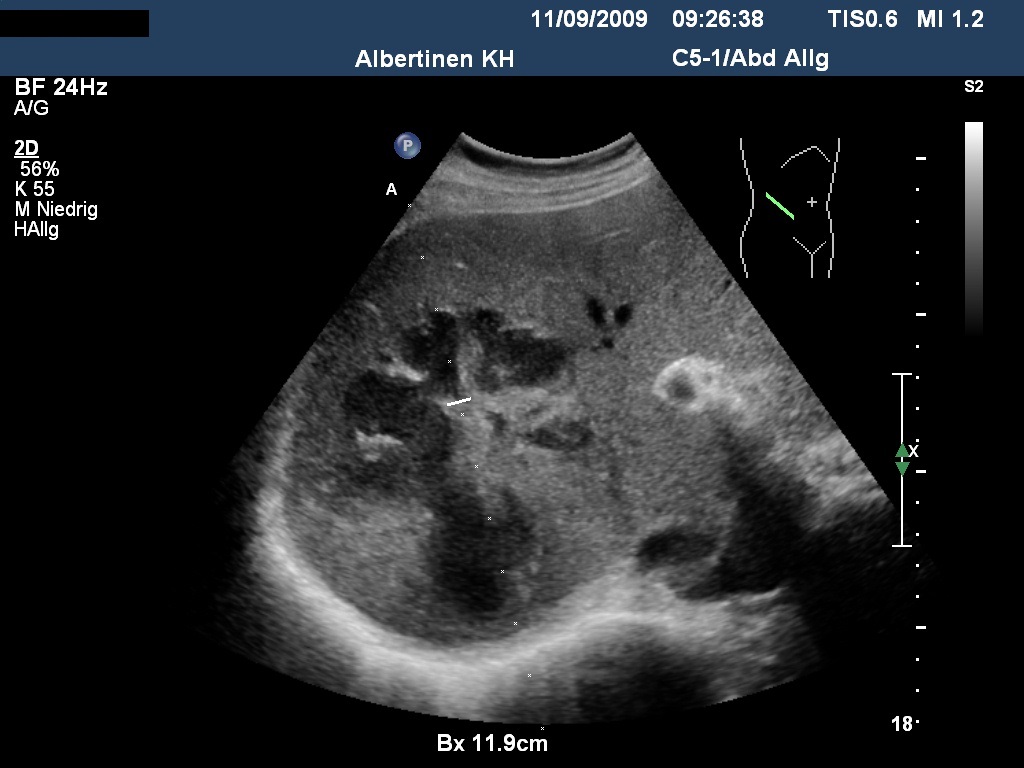Sonographie: Großer pyogener Leberabszeß vor Drainageanlage (Mit freundlicher Genehmigung von sonographiebilder.de ©Albertinen-Diakoniewerk e.V., Hamburg)