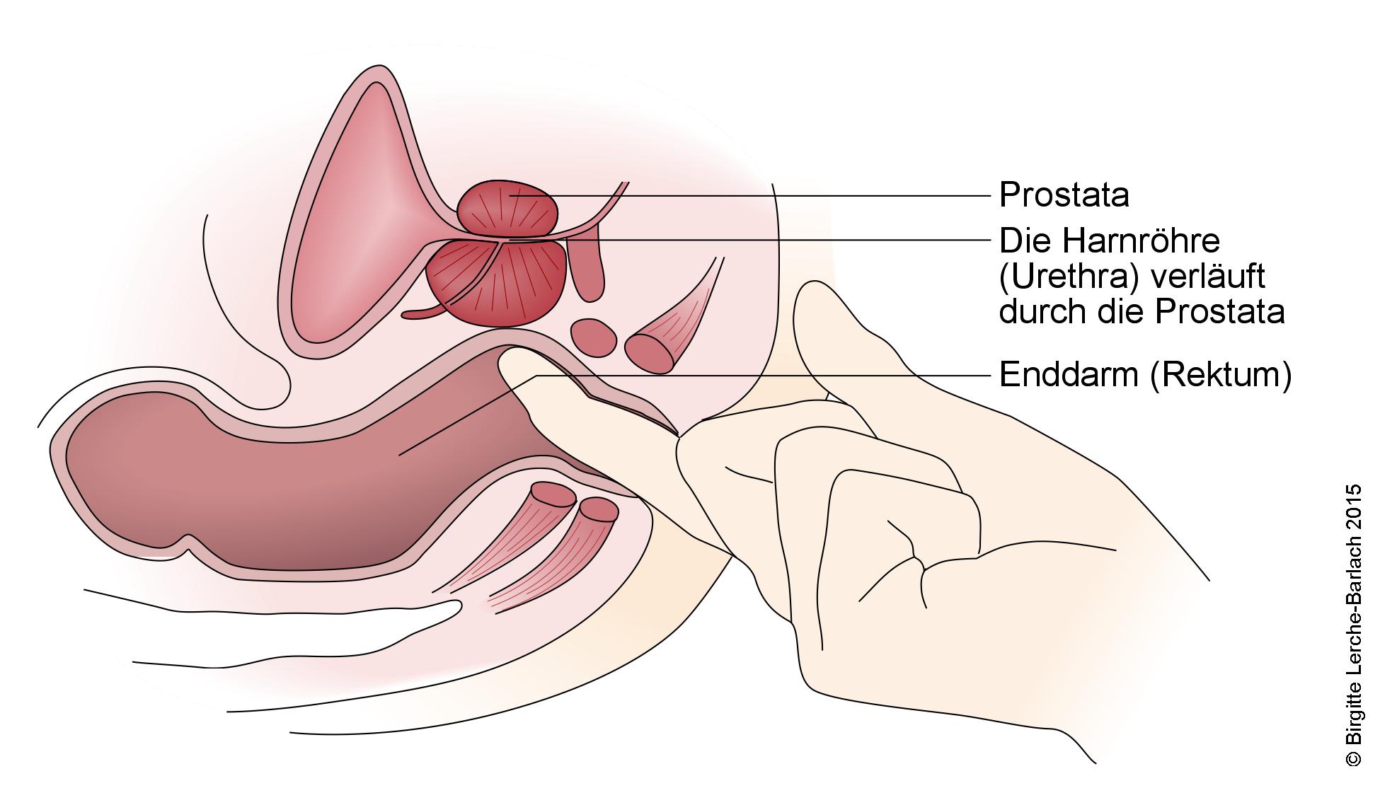 Untersuchung der Prostata