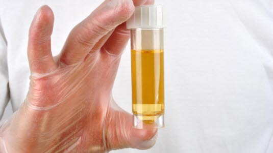 Urinprov för mikroalbumin - Medibas