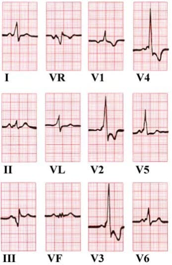 wolff-parkinson-white-ekg.jpg