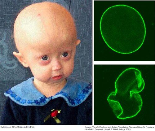 Progeria