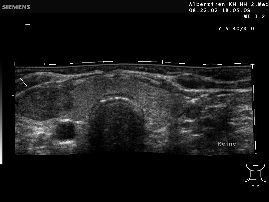 Solider Schilddrüsenknoten rechts in der Sonografie (mit freundlicher Genehmigung von sonographiebilder.de ©Albertinen-Diakoniewerk e. V., Hamburg).