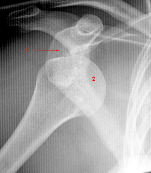 Typische Schulterluxation nach ventro-kaudal: 1. Glenoid, 2. Caput humeri.