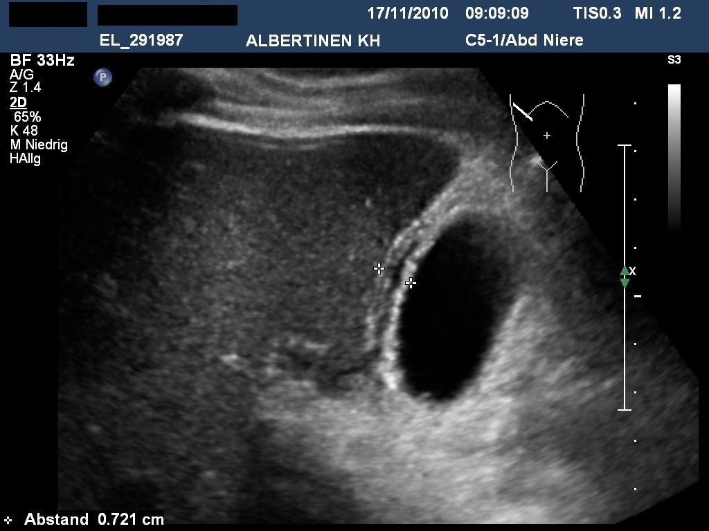 Sonografie: Akute Cholezystitis mit Wandverdickung (mit freundlicher Genehmigung von sonographiebilder.de ©Albertinen-Diakoniewerk e. V., Hamburg).